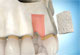 Bone Grafting Thumbnail