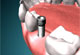 Dental Implants Thumbnail