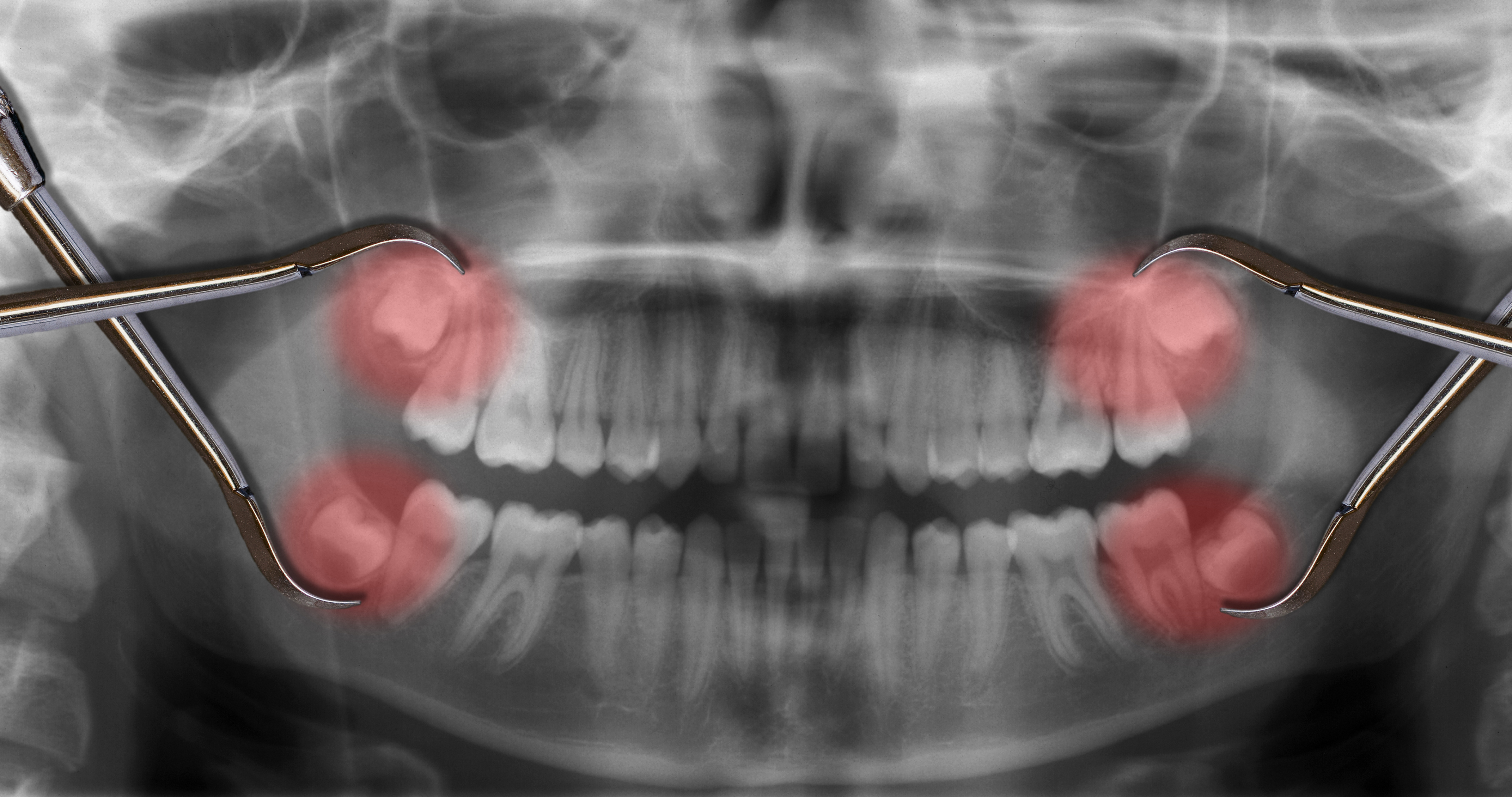 Wisdom Teeth - Southbridge, MA - Central New England Oral and Maxillofacial Surgery