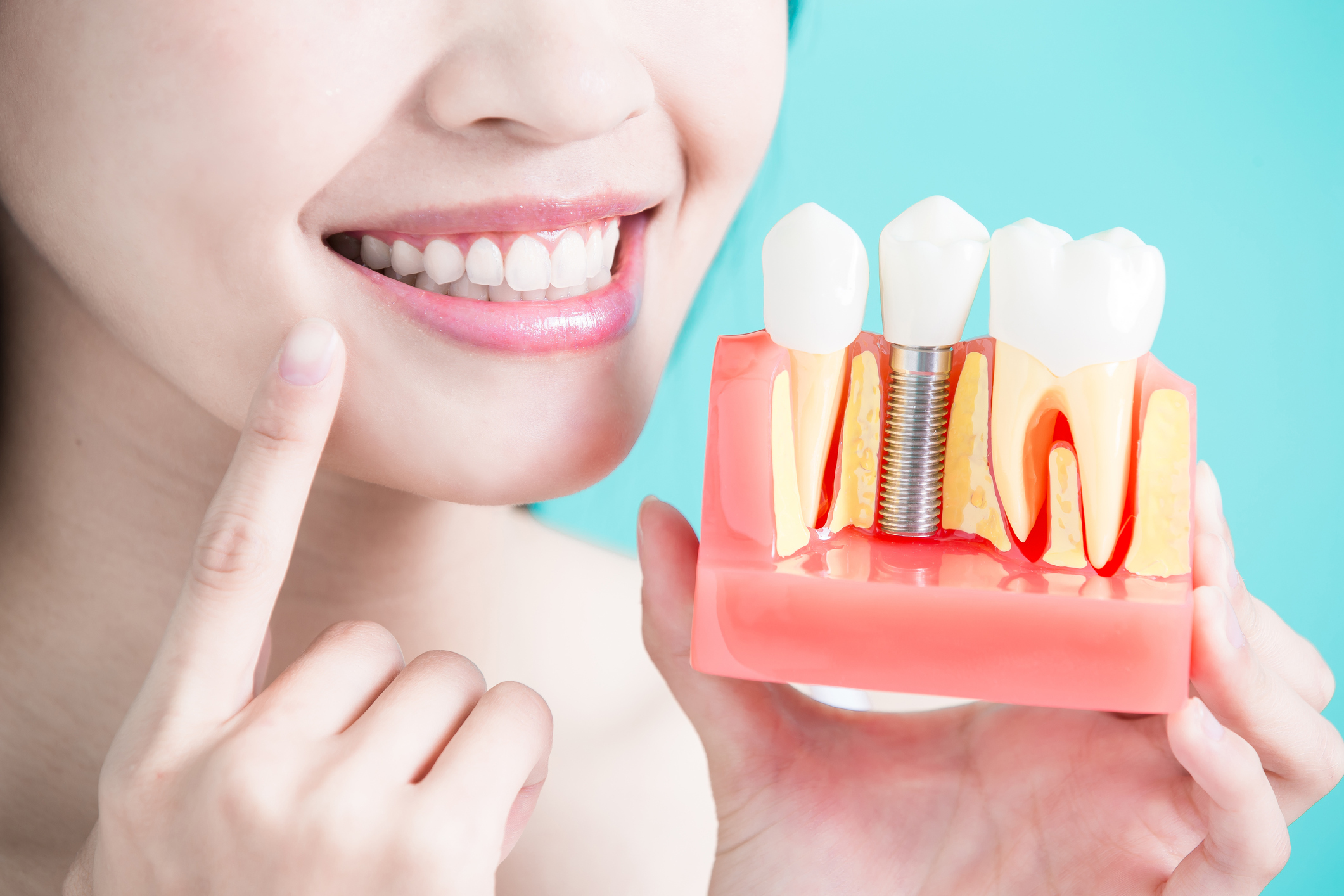 dental implants with person smiling