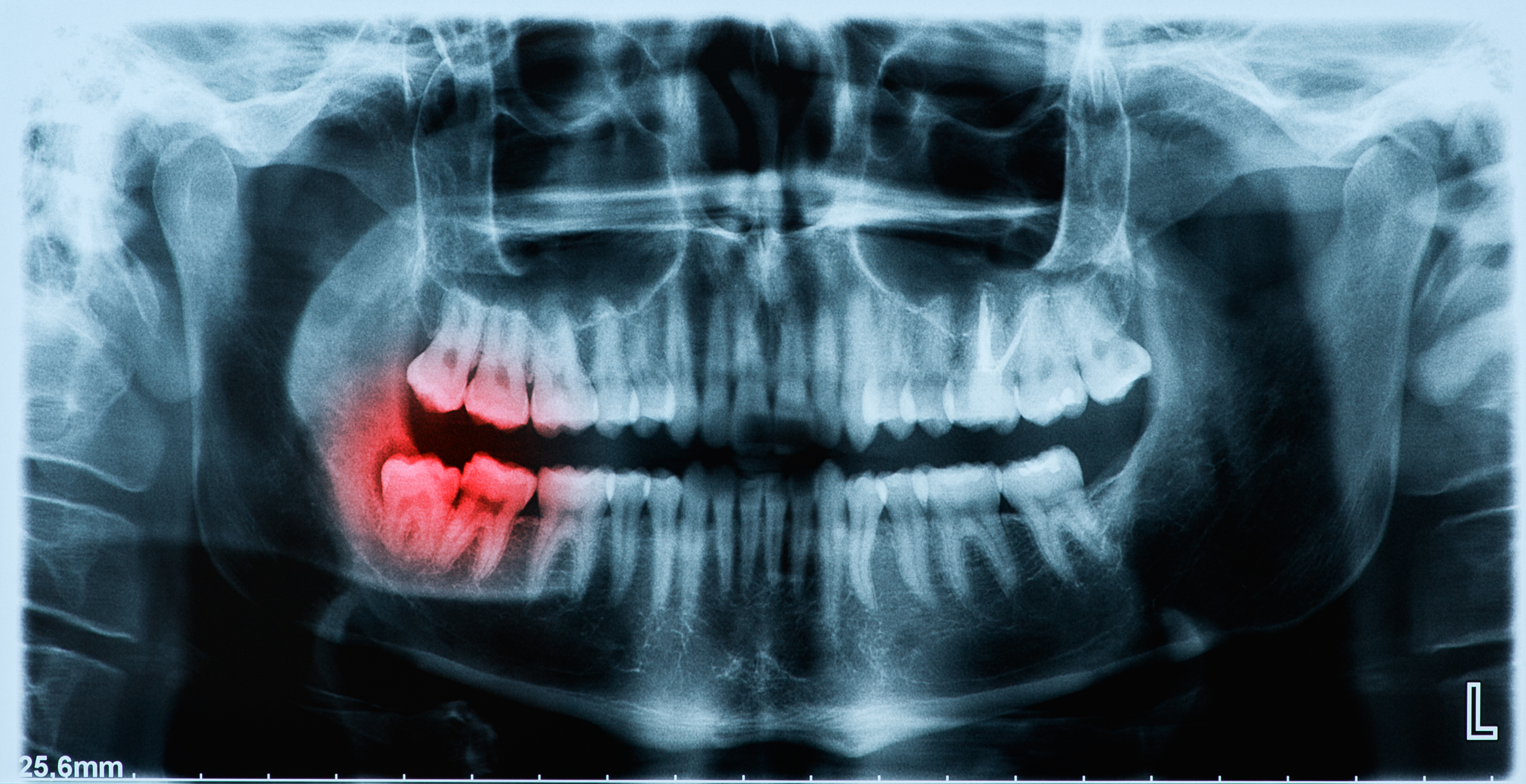 Impacted Canines - Pomfret, CT - Central New England Oral and Maxillofacial Surgery