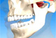 TMJ Disorders Thumbnail