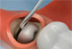 Wisdom Teeth Extraction Thumbnail